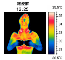 サーモグラフィーで計ったインディバ施術を受ける前の全身体温写真