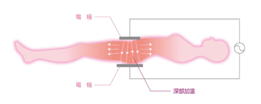 2つの電極をお腹と背中に置き、深部加温が可能なインディバ施術のイメージイラスト